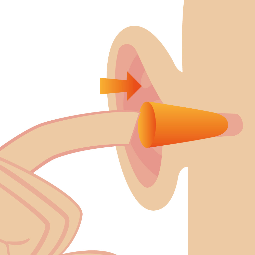 Illustration de la mise en place d'un bouchon d'oreilles jetable non modulable dans le canal auditif