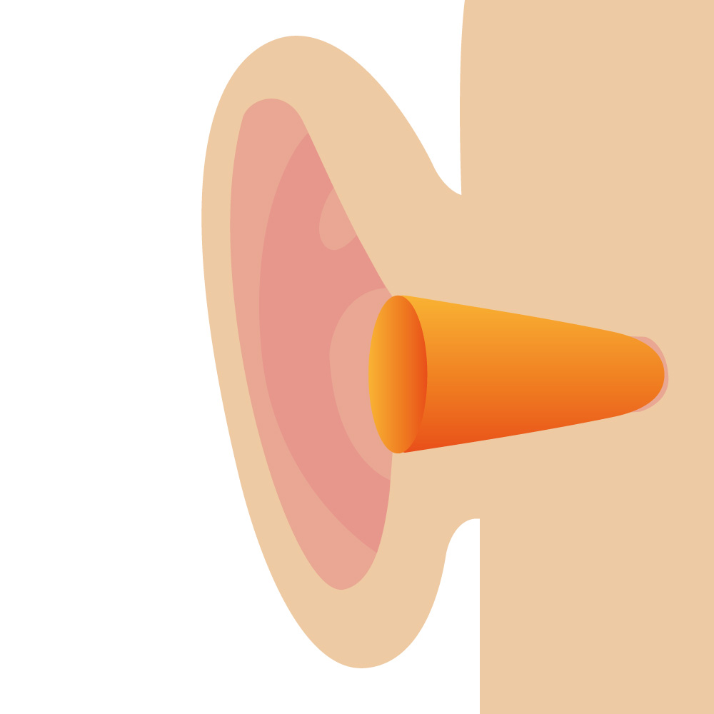 Illustration de la position d'un bouchon d'oreilles jetable non modulable dans le canal auditif